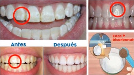 Excretar Serafín seriamente Centinela Digital - Trucos para eliminar las manchas amarillas de los  dientes